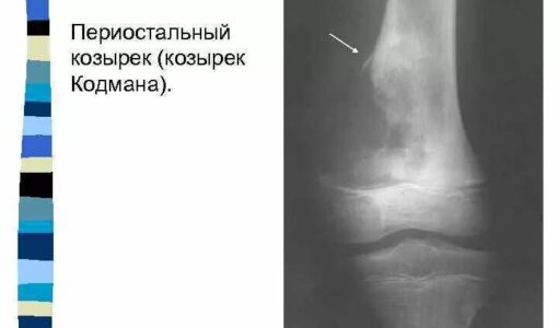 Козырек кодмана